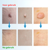 RestoreSkin™  | Pijnloos & effectief!