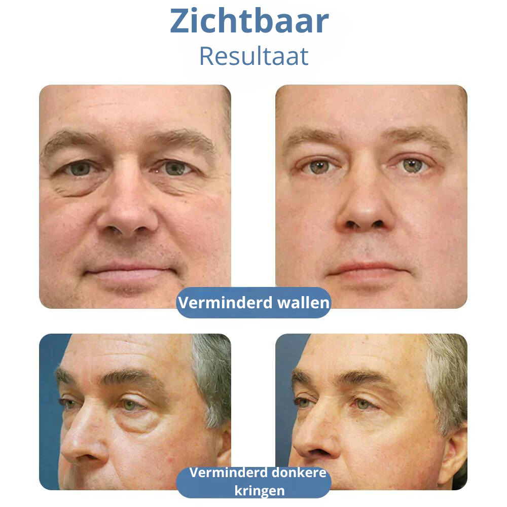 OPENEYES™ l Nooit meer rimpels!